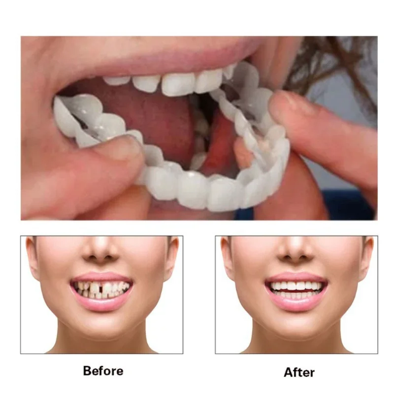 Denture Cover Veneer Snap-on T - Teeth Whitening Veneers reseña y precio
