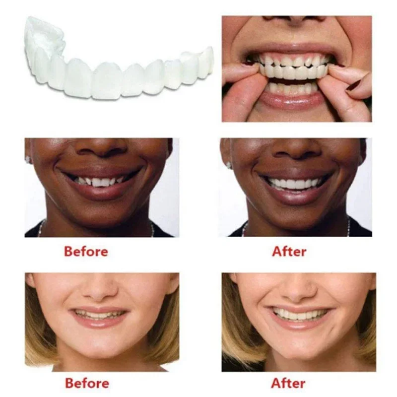 Denture Cover Veneer Snap-on T - Teeth Whitening Veneers reseña y precio