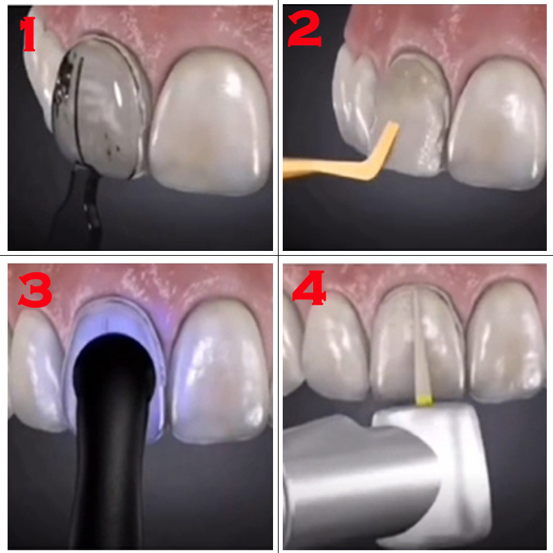 Dental Mold for Composite Resi - Teeth Whitening Veneers reseña y precio