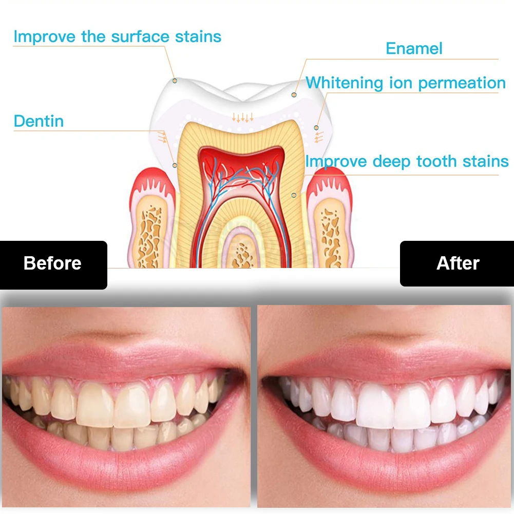 Dental Teeth Whitening Kit Min - Teeth Whitening Hydrogen Peroxide reseña y precio